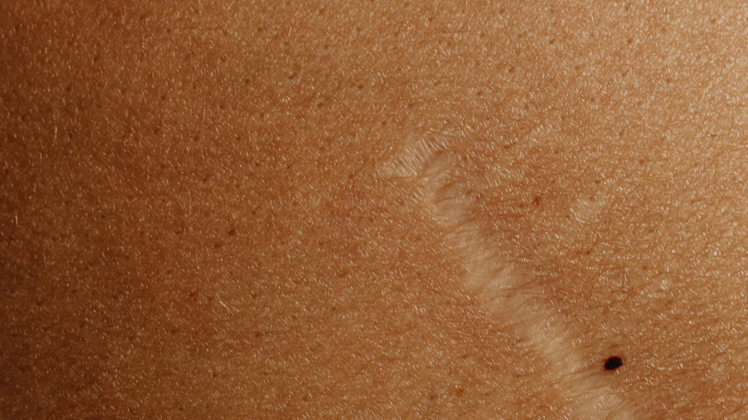 Quelle huile végétale pour faire disparaître les cicatrices ?