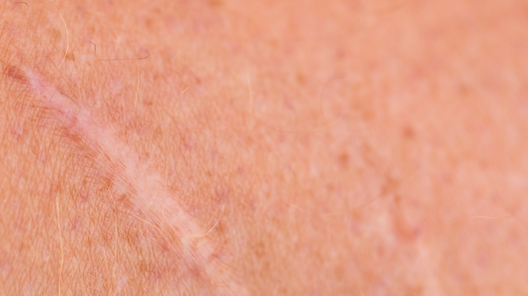 Comment atténuer naturellement une cicatrice ?