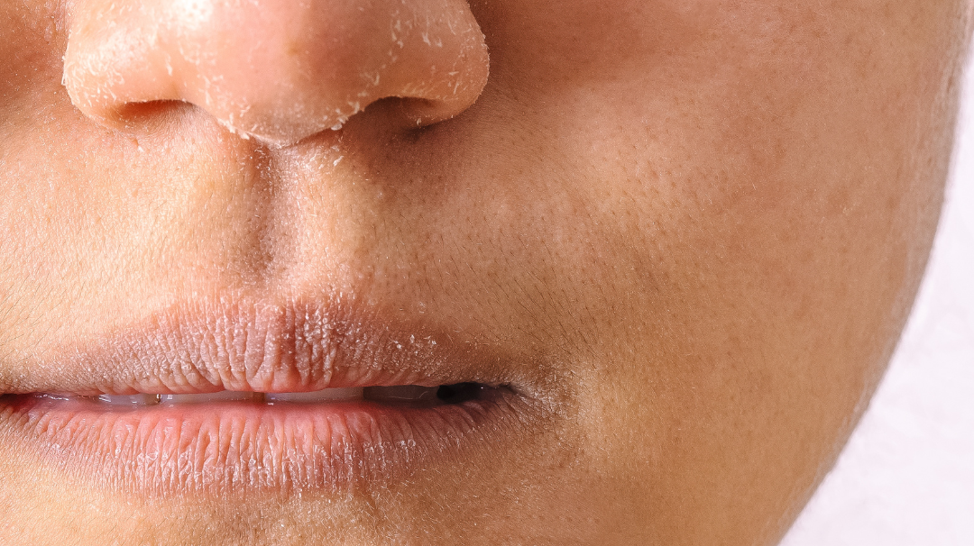 Ma peau tiraille l'hiver, quelles solutions naturelles ?