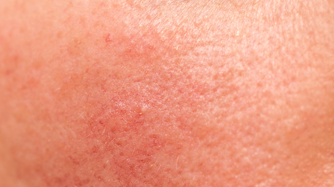 L’huile végétale d’amande douce est-elle efficace sur les peaux irritées ?