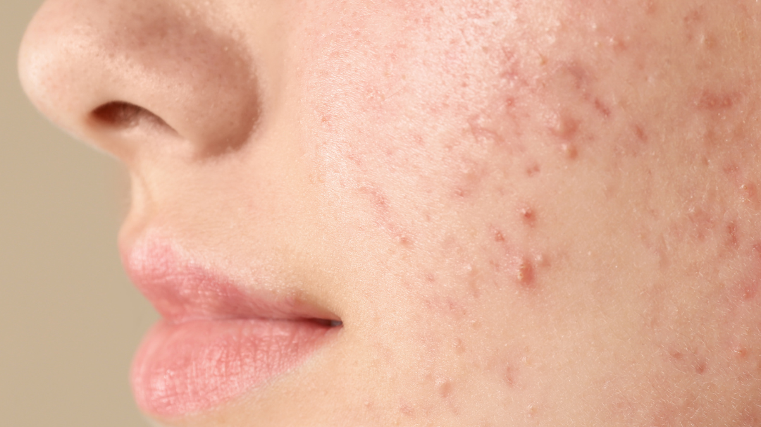 L’huile de chanvre contre l’acné