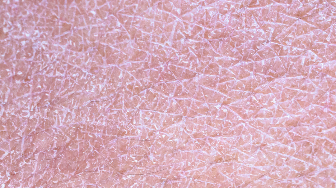 Comment prendre soin des peaux déshydratées