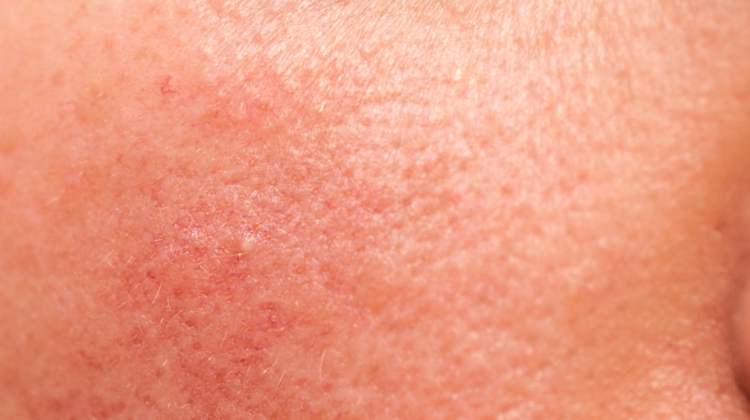 Quelle huile végétale pour ma peau sensible