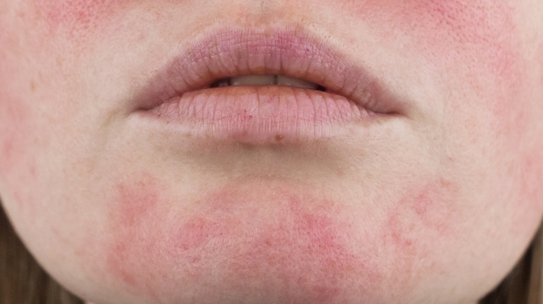 Lutter contre le psoriasis grâce à l’huile de chanvre