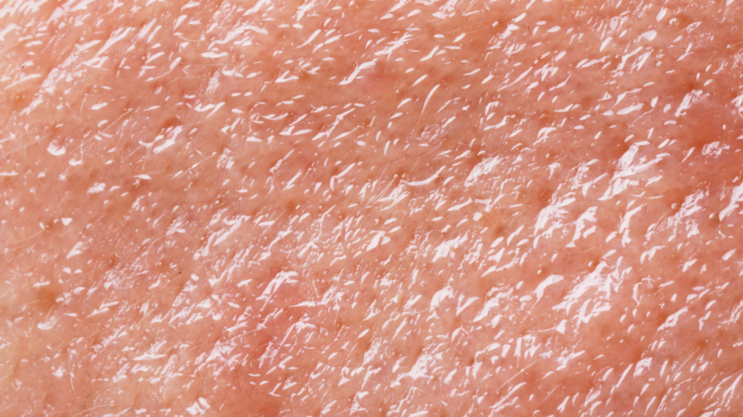 Quelle huile végétale pour une peau grasse ?