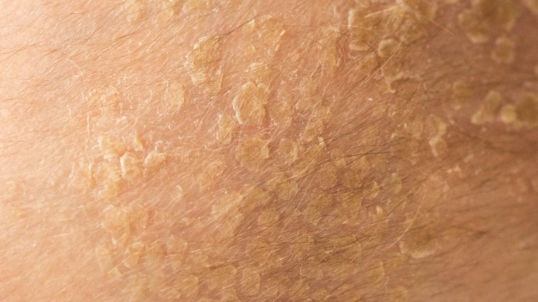 Comment traiter naturellement la dermatite séborrhéique ?
