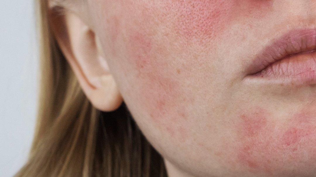 L’huile de bourrache est-elle efficace pour lutter contrer l'eczéma ?