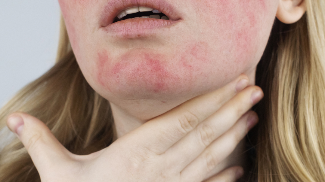 Quelle huile pour soigner mon eczéma naturellement ?