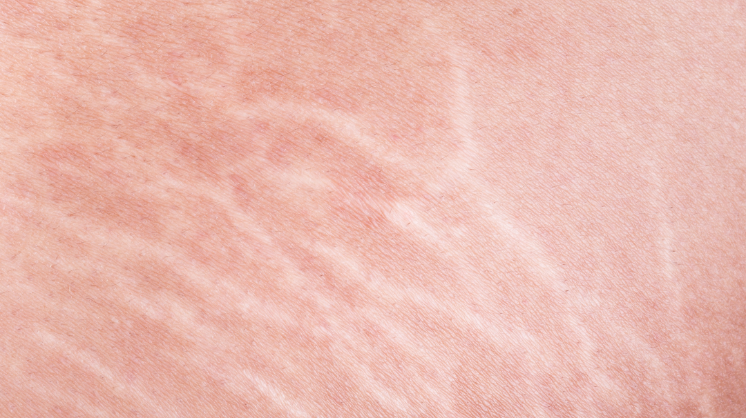 Comment atténuer naturellement ses vergetures ?