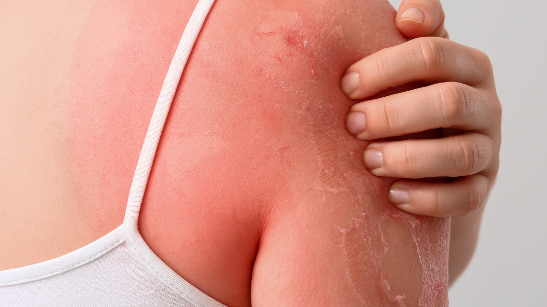 Peut-on appliquer de l’huile d’amande douce en cas de brûlure ?