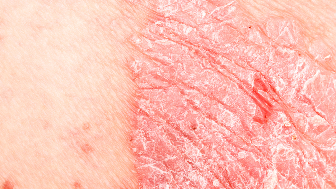Traitement naturel du psoriasis : comment soulager votre peau