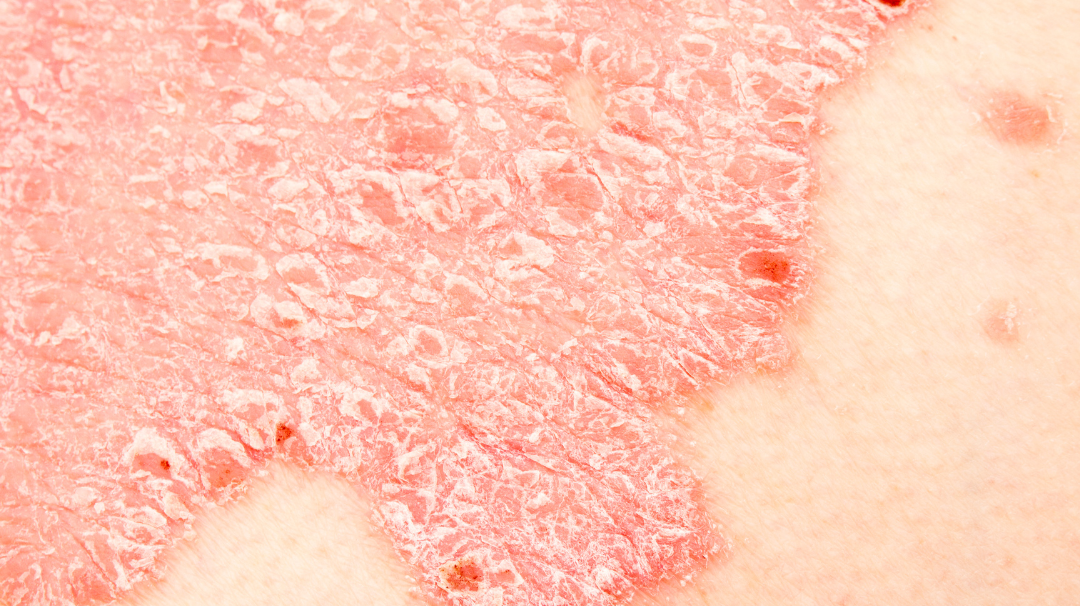 Comment traiter naturellement l'eczéma ?