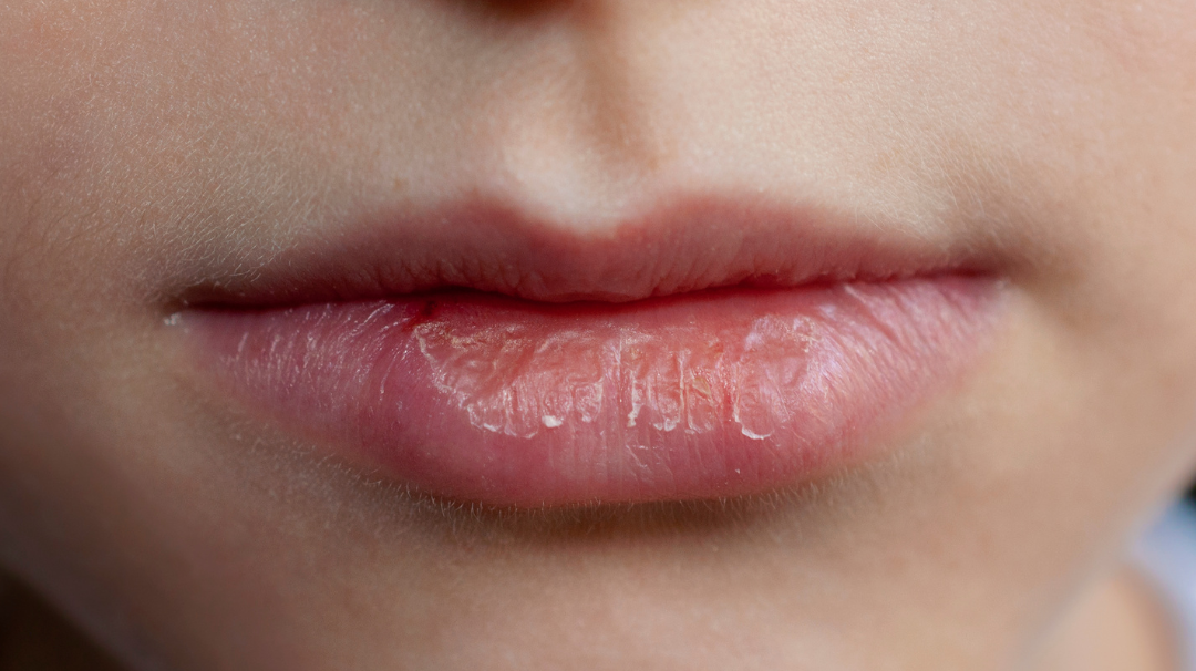 Quelle huile végétale pour des lèvres sèches ?