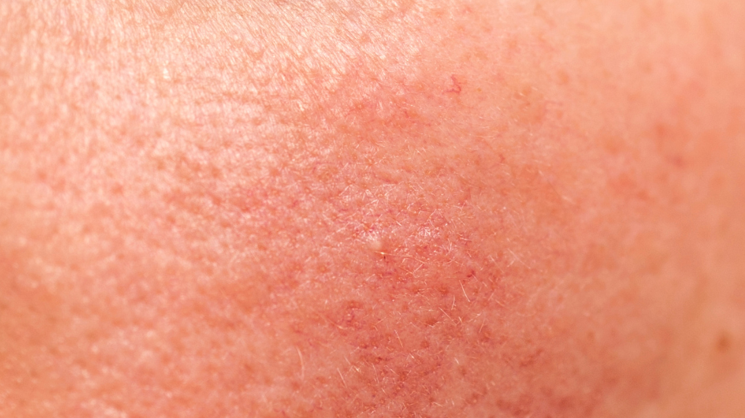 L’huile de chanvre, anti rougeur efficace