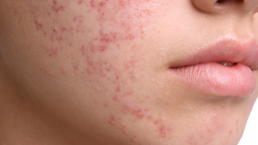 L'huile de noisette oden est-elle adaptée si vous avez de l'acné ?