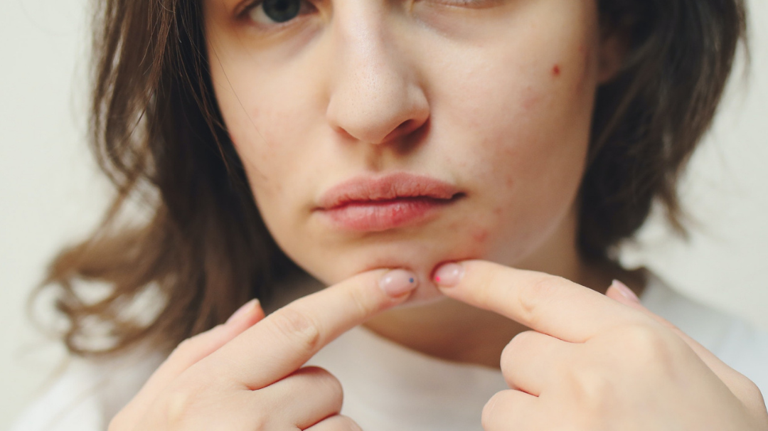 Comment traiter naturellement ses imperfections de peau ?