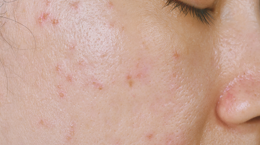 Comment traiter naturellement l'acné ?