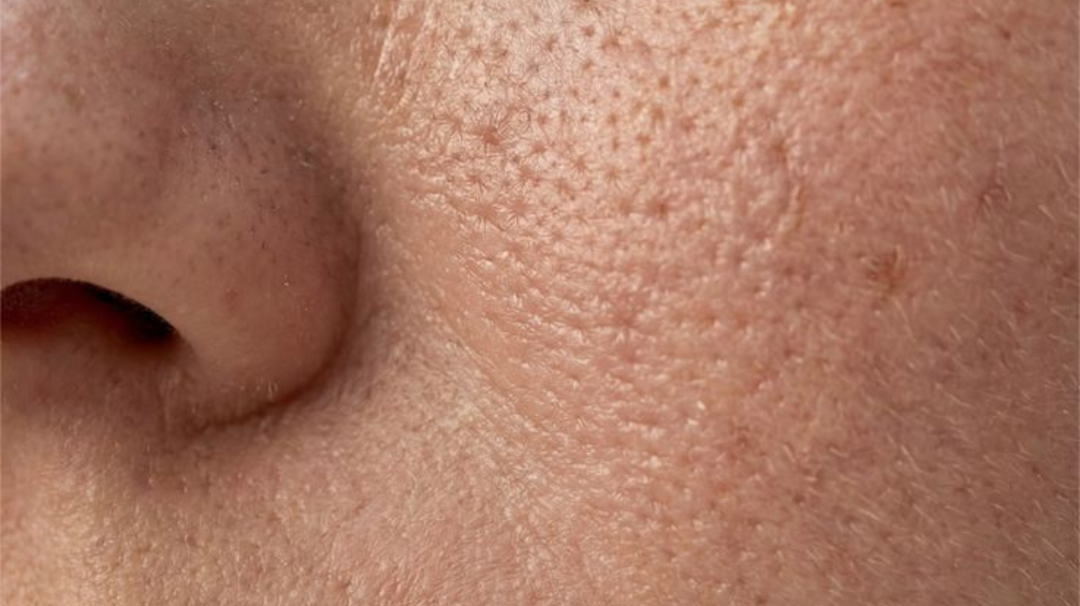 5 solutions naturelles pour resserrer les pores dilatés du visage