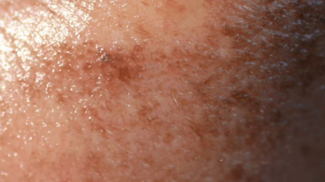 5 soins naturels pour atténuer les taches brunes du visage