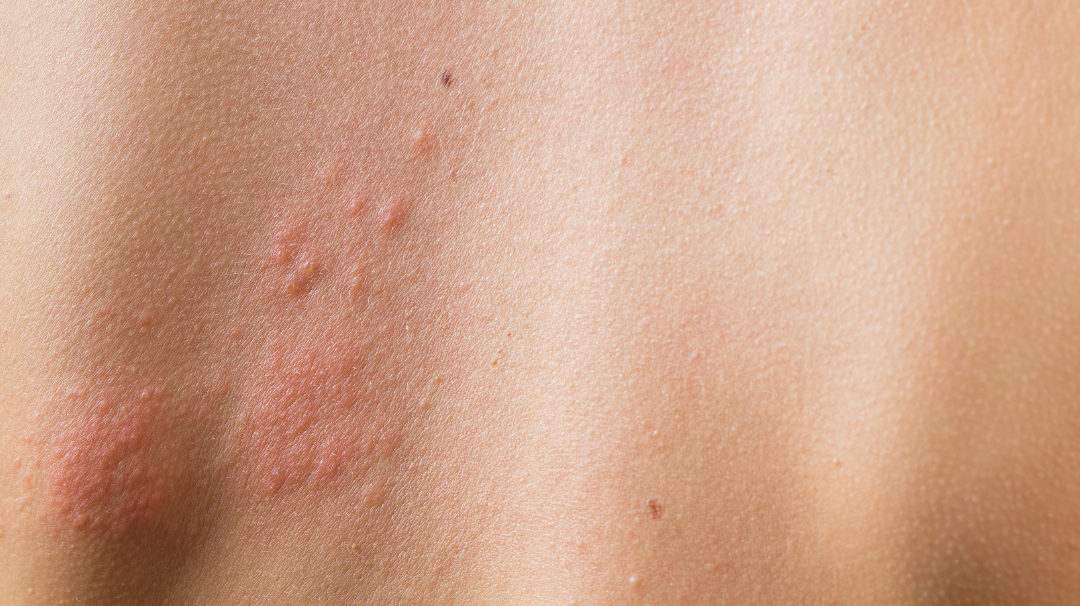 Urticaire : causes, et soins naturels pour soulager les crises