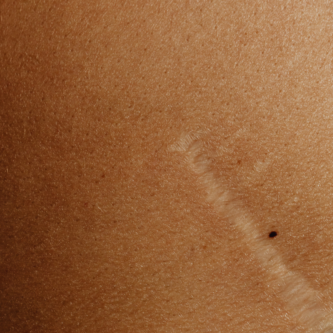 Quelle huile végétale pour faire disparaître les cicatrices ?