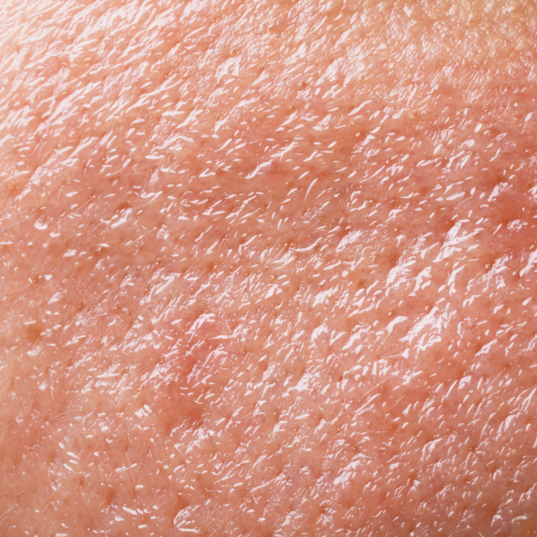 Quelle huile végétale pour une peau grasse ?