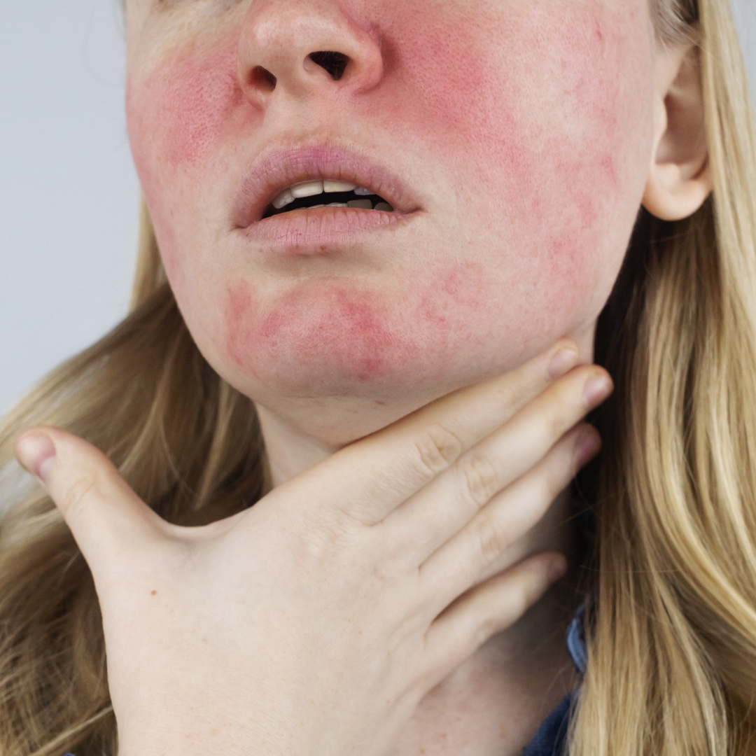 Quelle huile pour soigner mon eczéma naturellement ?