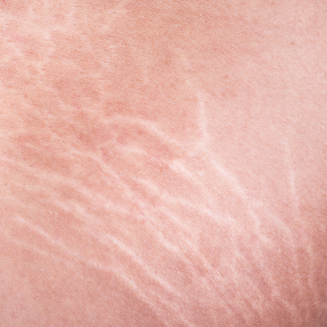 Comment atténuer naturellement ses vergetures ?