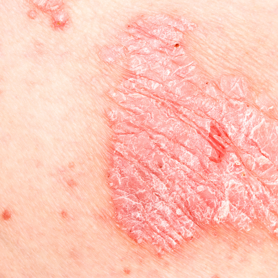 Traitement naturel du psoriasis : comment soulager votre peau