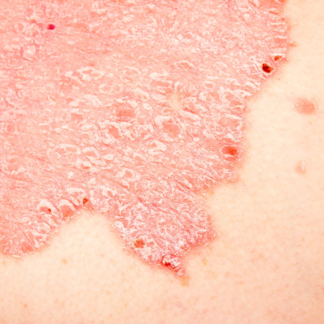 Comment traiter naturellement l'eczéma ?