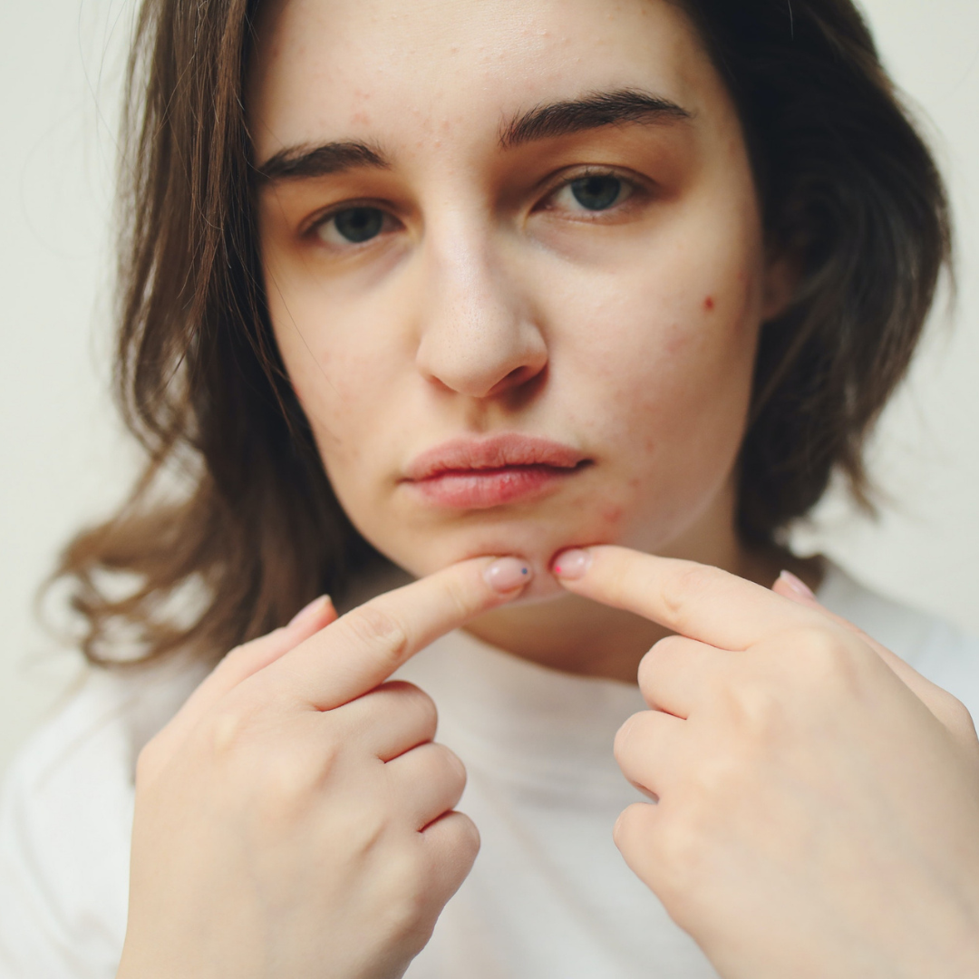 Comment traiter naturellement ses imperfections de peau ?