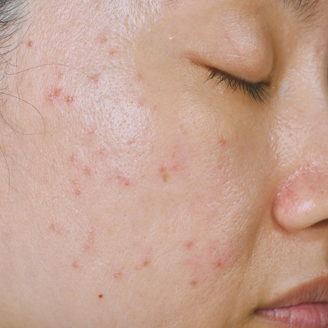 Comment traiter naturellement l'acné ?