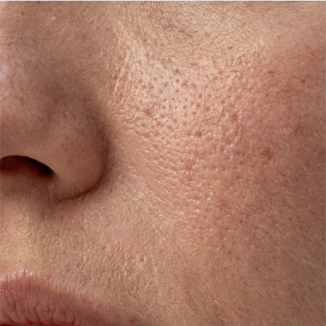 5 solutions naturelles pour resserrer les pores dilatés du visage