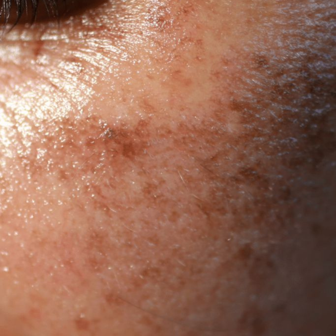 5 soins naturels pour atténuer les taches brunes du visage