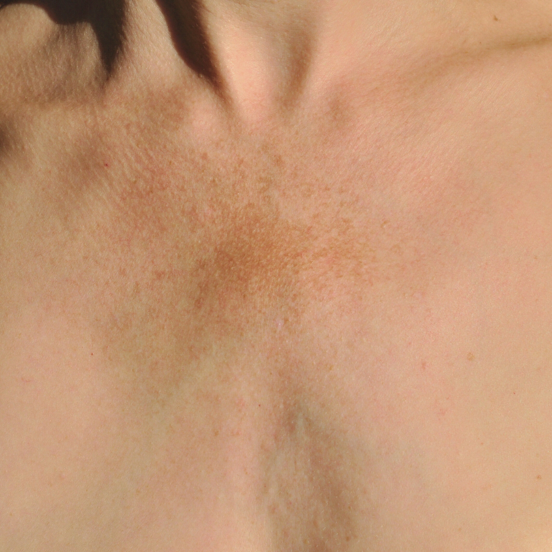 Taches pigmentaires : comment les atténuer ?