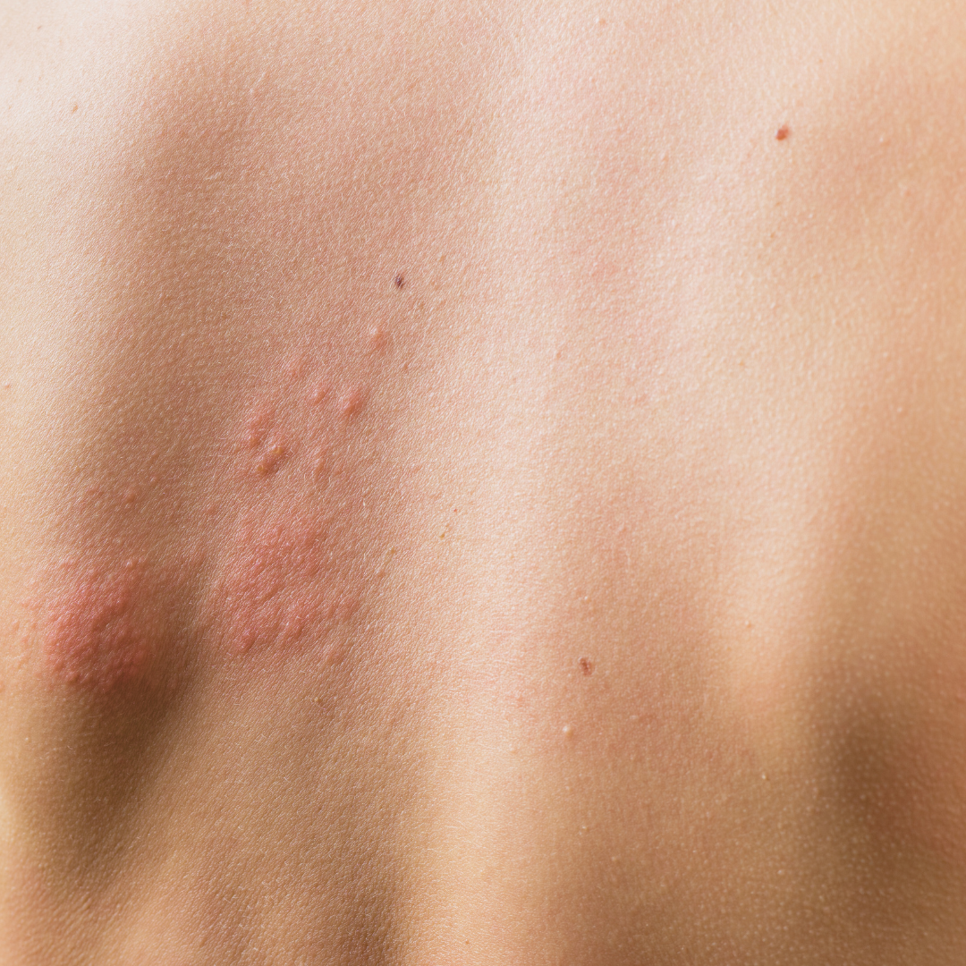 Urticaire : causes, et soins naturels pour soulager les crises